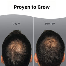 Before and after comparison of hair growth treatment showing a person's head with hair density improvement over 180 days.